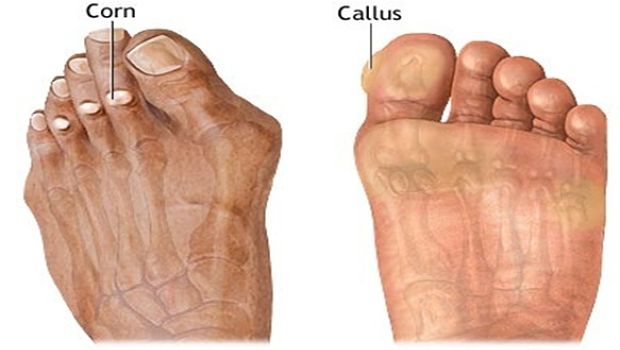 how to remove calluses