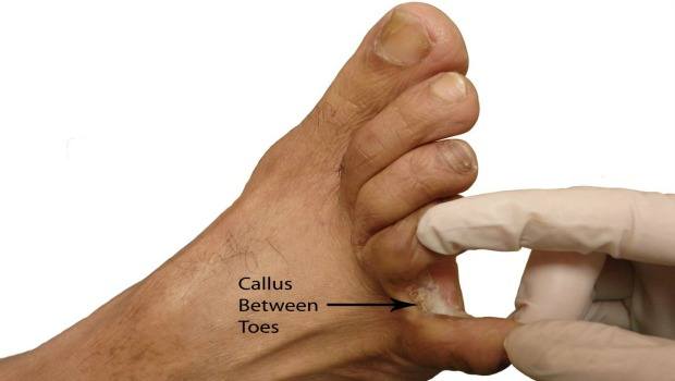 causes of corns & bunions on your feet download
