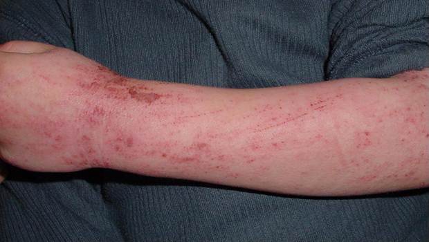 types of skin infections