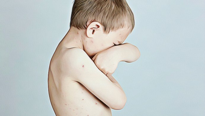 skin infections in children