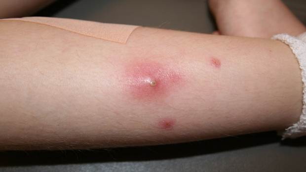 types of skin infections