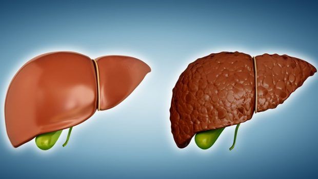 Healthy diet for liver cirrhosis patient – good and bad foods to eat