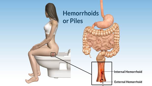 home remedies for hemorrhoids