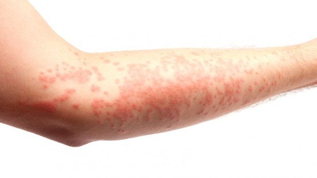 home remedies for eczema 