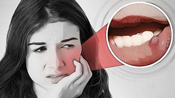 home remedies for mouth ulcers in adults
