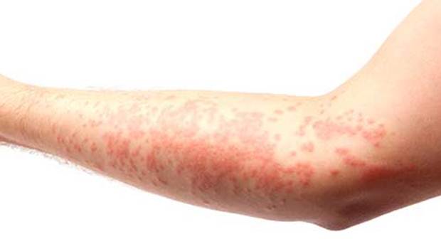 skin-rash-and-cancer