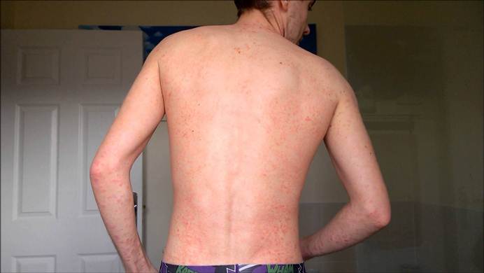 diet for psoriasis