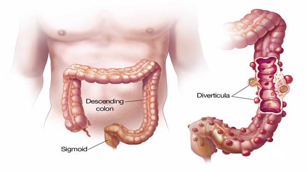 home remedies for diverticulitis