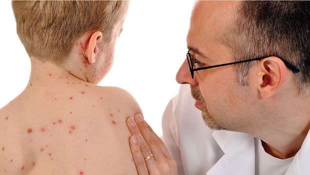 home remedies for chickenpox in children