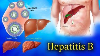 home remedies for hepatitis