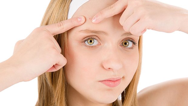 home remedies for whiteheads