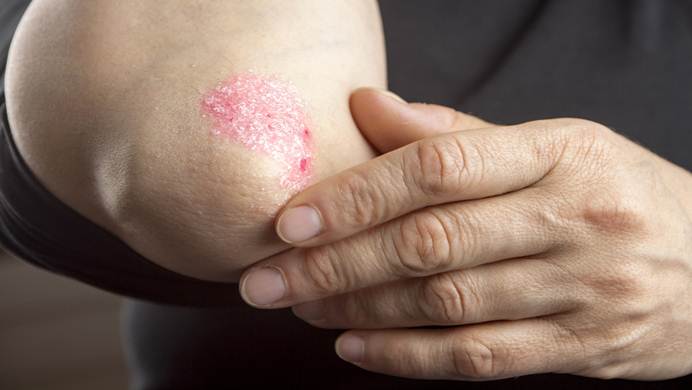 how to prevent psoriasis