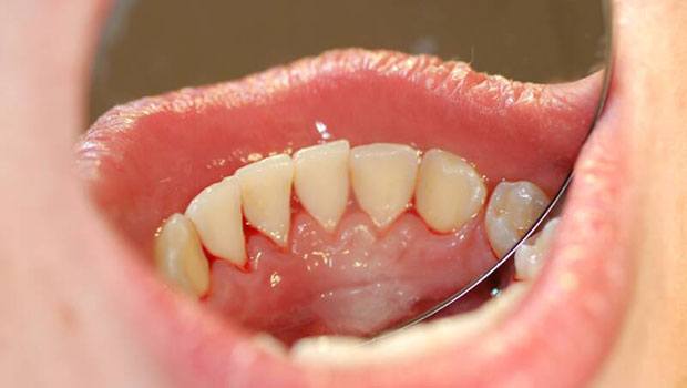 how to reduce wisdom teeth swelling