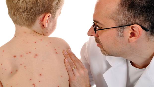 how to treat measles