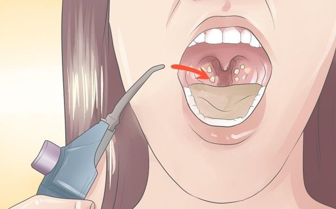 home remedies for tonsil stones - water pressure