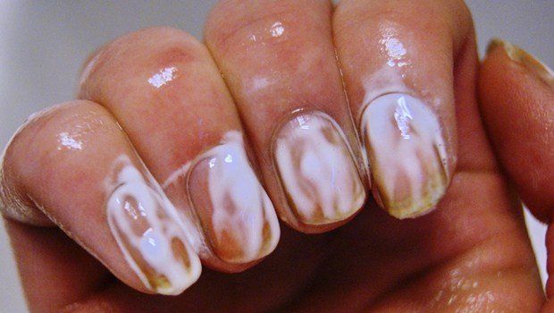 how to get rid of yellow nails