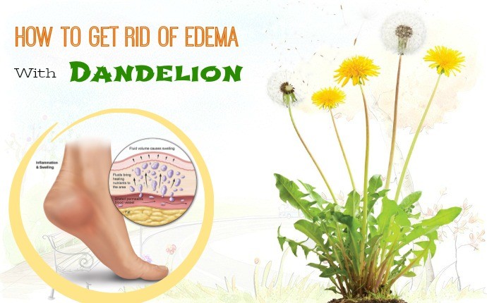 how to get rid of edema - dandelion