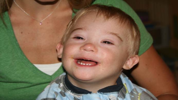 facts about Down syndrome