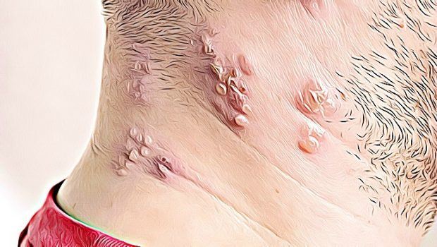 home remedies for shingles