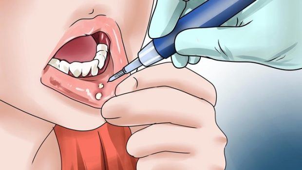 home remedies for tongue ulcers