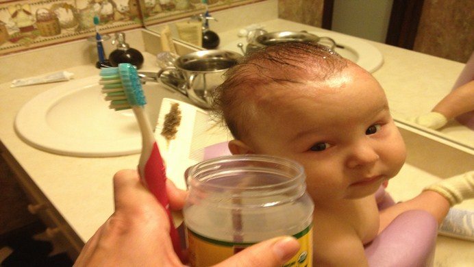how to get rid of cradle cap-wash the head every day