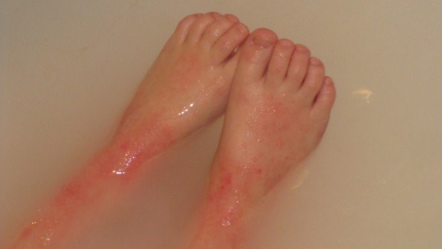 how to get rid of eczema scars on legs