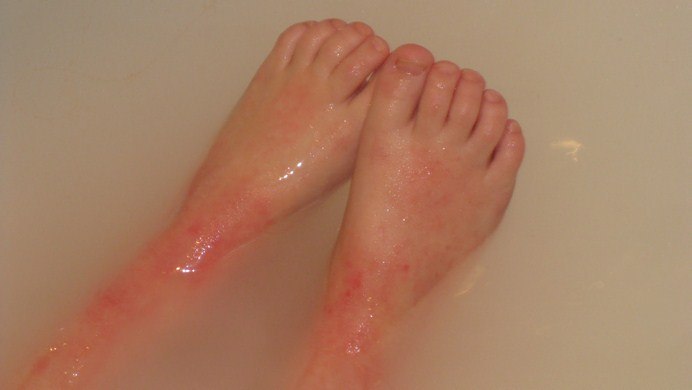 how to get rid of eczema scars on legs