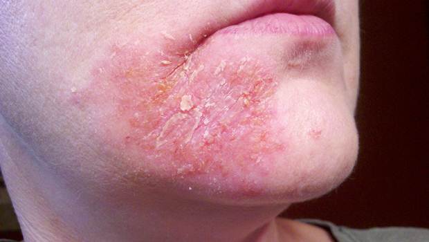 home remedies for dermatitis