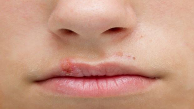 how to prevent cold sores-avoid touching cold sores unecessarily