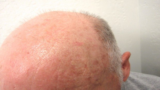 how to treat alopecia-check your insulin levels