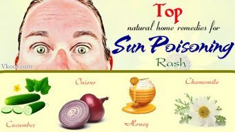 natural home remedies for sun poisoning