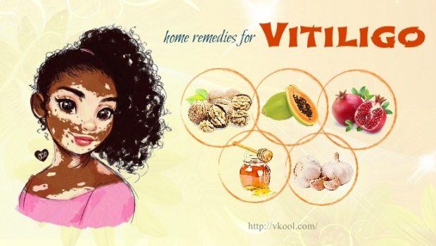 36 Natural Home Remedies For Vitiligo Disease Treatment Quickly