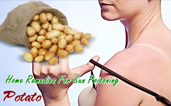 home remedies for sun poisoning - potato