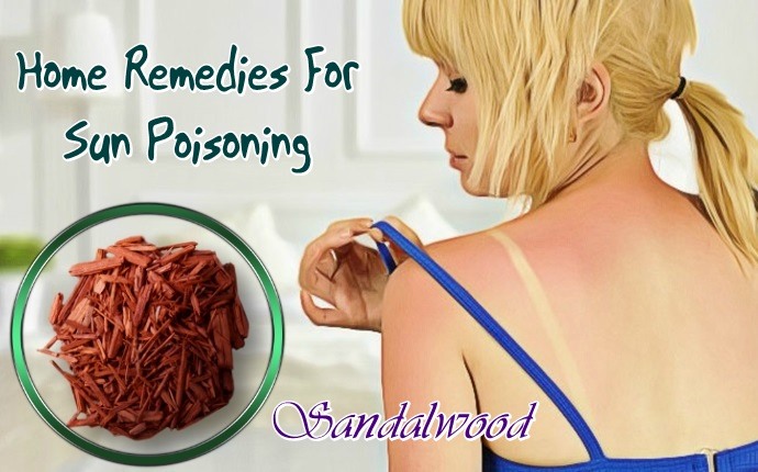 home remedies for sun poisoning - sandalwood
