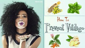 how to prevent vitiligo