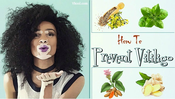how to prevent vitiligo
