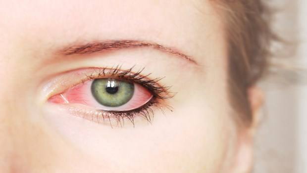 tea tree oil benefits-relief from pink eye