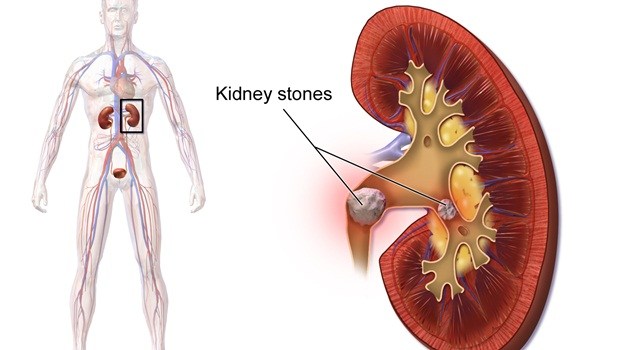 why is junk food bad - contribute to the formation of kidney stones
