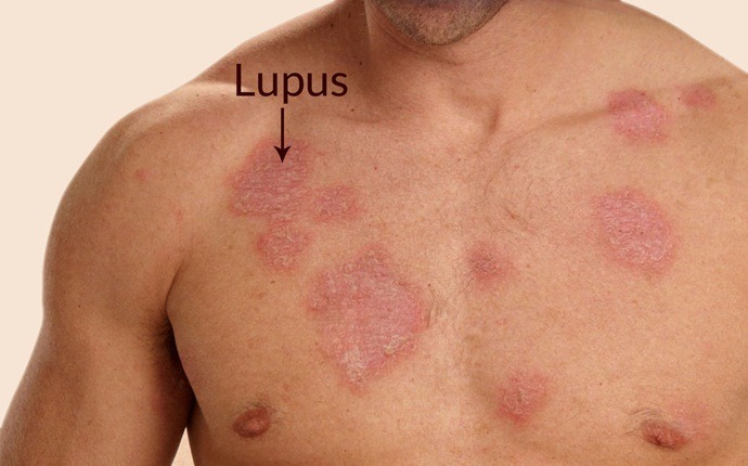 benefits of omega-3 - reduce systemic lupus erythematosus (sle)