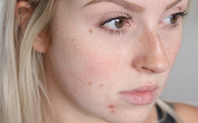 how to use turmeric for acne - turmeric for treating acne on face