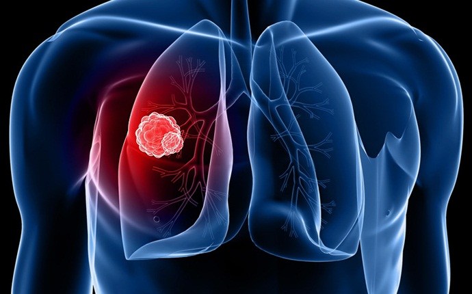 shortness of breath causes - lung cancer