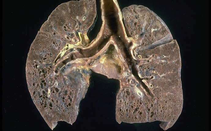 shortness of breath causes - sarcoidosis