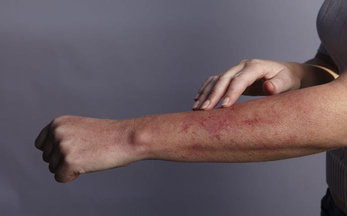 symptoms of hiv - seborrheic dermatitis and rashes