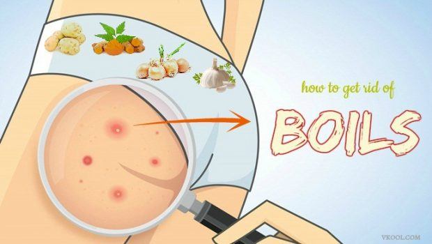 how to get rid of boils fast