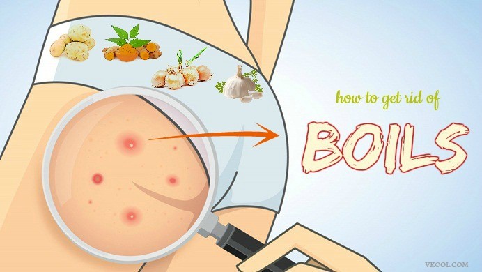 how to get rid of boils fast