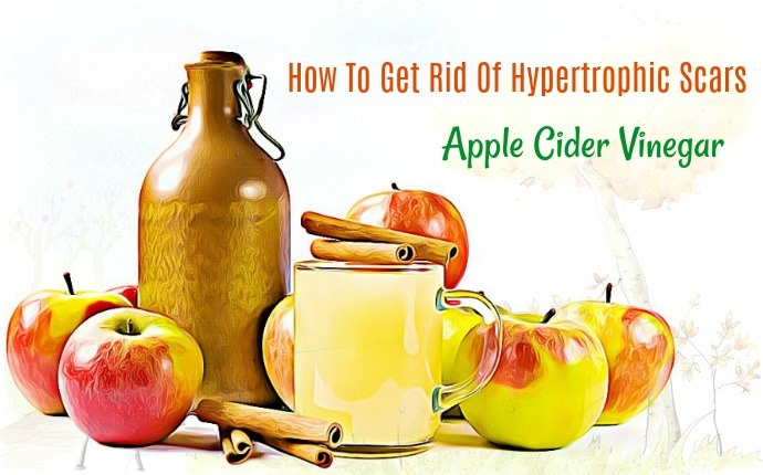 how to get rid of hypertrophic scars - apple cider vinegar