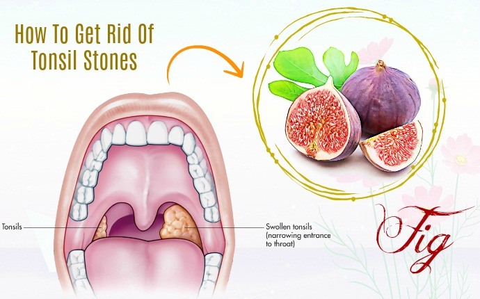 how to get rid of tonsil stones - fig