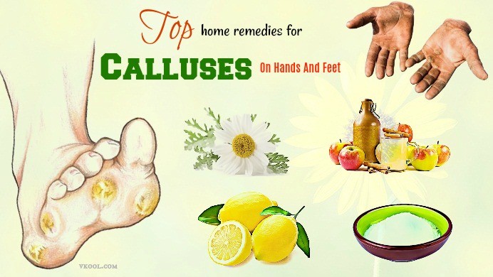 home remedies for calluses on feet