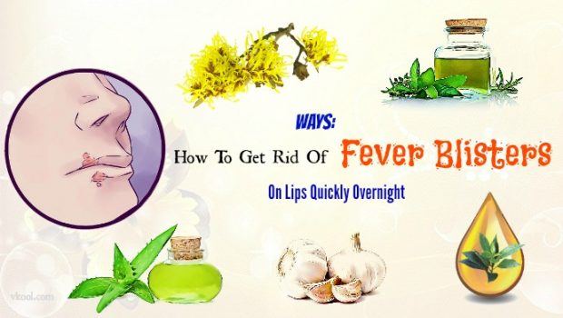 how to get rid of fever blisters overnight
