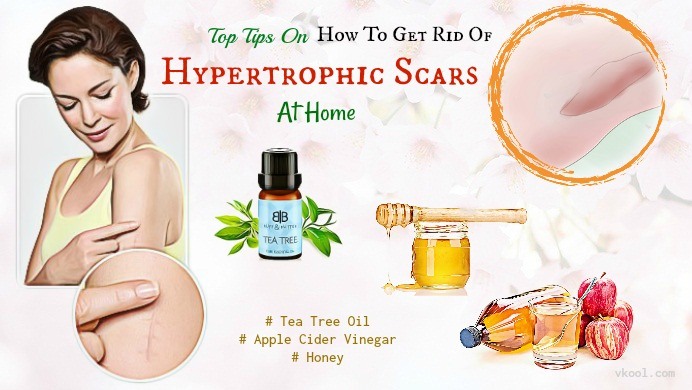 how to get rid of hypertrophic scars naturally